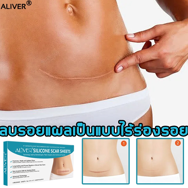 【จัดส่งที่รวดเร็ว】Aliver แผ่นแปะแผลเป็น ซ่อมแซมรอยแผลเป็นและลดการสร้างเม็ดสีเมลานิน สามารถใช้กับแผลไ