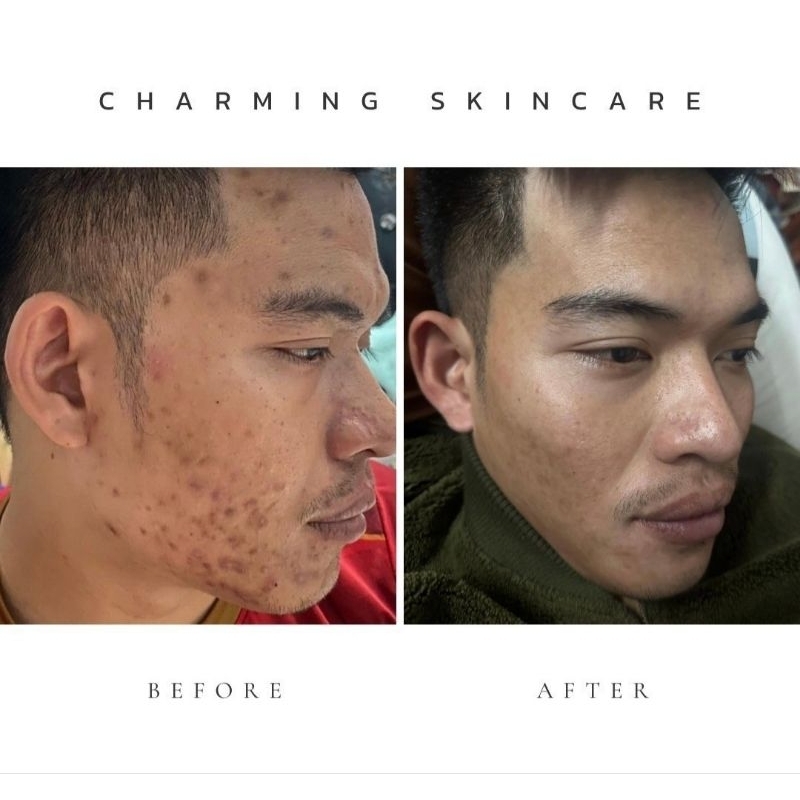 ครีมชาร์มมิ่ง สกิน charming skin เซตสุดคุ้ม ขายดี(ครีมเล็ก+เซรั่ม +กันแดด) - รูปที่ 6
