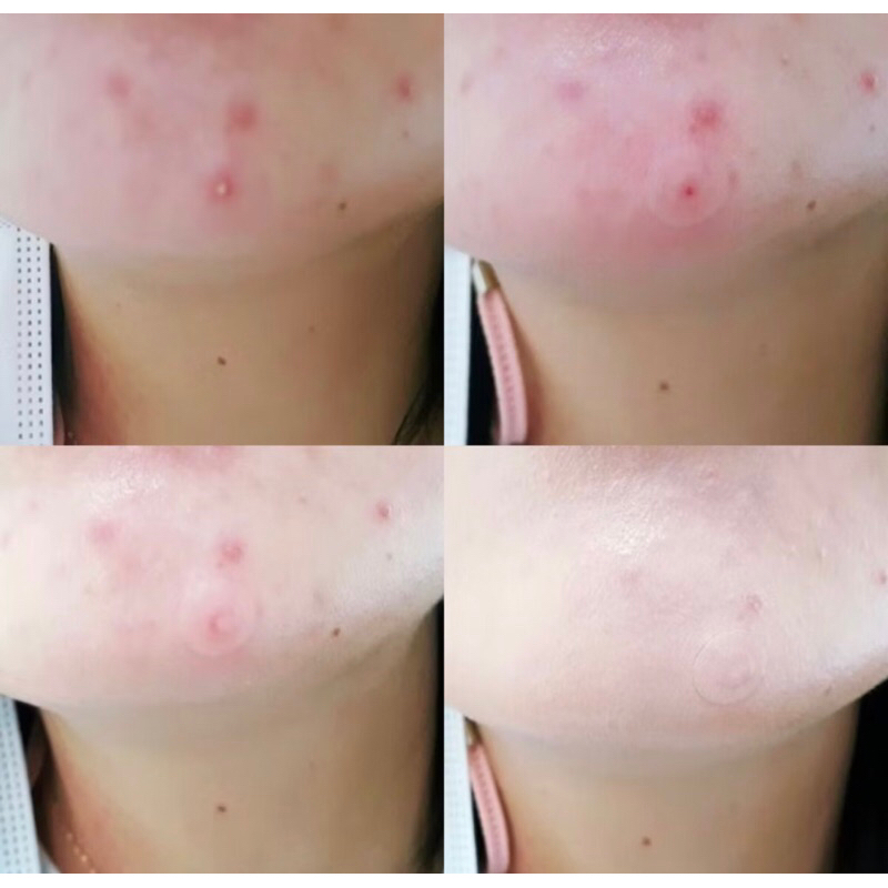 แท้ พร้อมส่งแผ่นแปะสิว Olive Young Acne care Plus spot รูปที่ 5