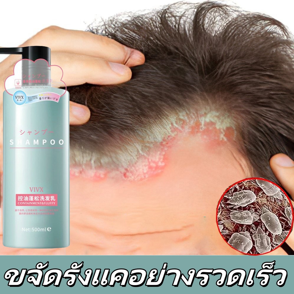 แชมพูแก้คัน ยาสระผม ยาสระผมขจัดรังแค 500ml ยาสระผมผมร่วง แชมพูขจัดรังแค ควบคุมความมัน ขจัดรังแค ลดผมร่วง บํารุงรากผม