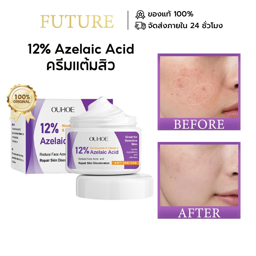 OUHOE 12% Azelaic Acid ครีมแต้มสิว Acne Cream เจลแต้ม สิวอักเสบ สิวหนอง สิวซีสต์ ลดโอกาสเกิดรอยดำรอยแดง อ่อนโยน