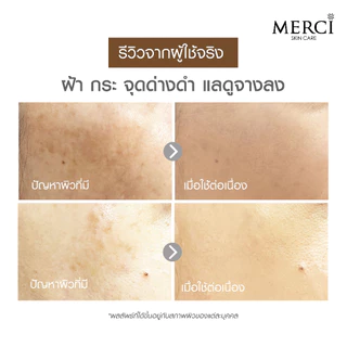 Merci วิตซี เมอร์ซี่ ฝ้า กระ Merci Vitamin C Melasma & Dark Spot Serum 15ml. 2ขวด แถมฟรี กันแดดวิตซี 1 ซอง มูลค่า 59 บาท