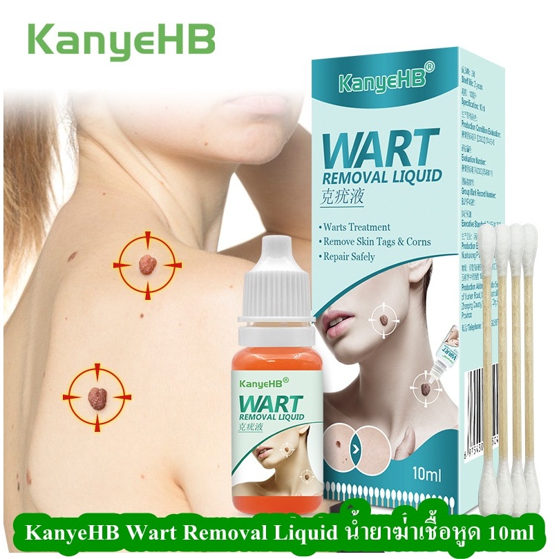 KanyeHB's wart-removing liquid, wart-removing cream, wart-removing cream 10ml