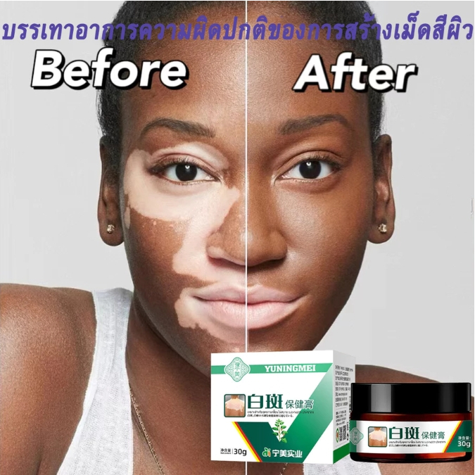 ครีมด่างขาว ครีมทาด่างขาว ครีมแก้ด่างขาวอย่างแข็งแกร่ง 20g บรรเทาต่างขาว เม็ดสีสะสมอย่างมีประสิทธิภาพ ปรับปรุงเมลามิน