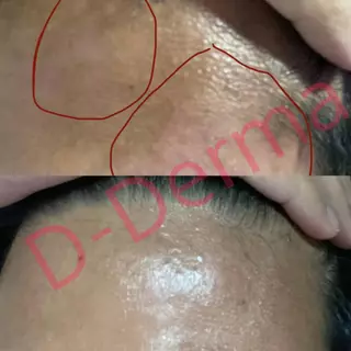 (ร้านเภสัช!!) เซรั่ม Anti-sebderm D-Derma เซ็บเดิร์ม ผิวแห้ง ลอก คัน ผิวหนังอักเสบ แพ้ง่าย ผดผื่น