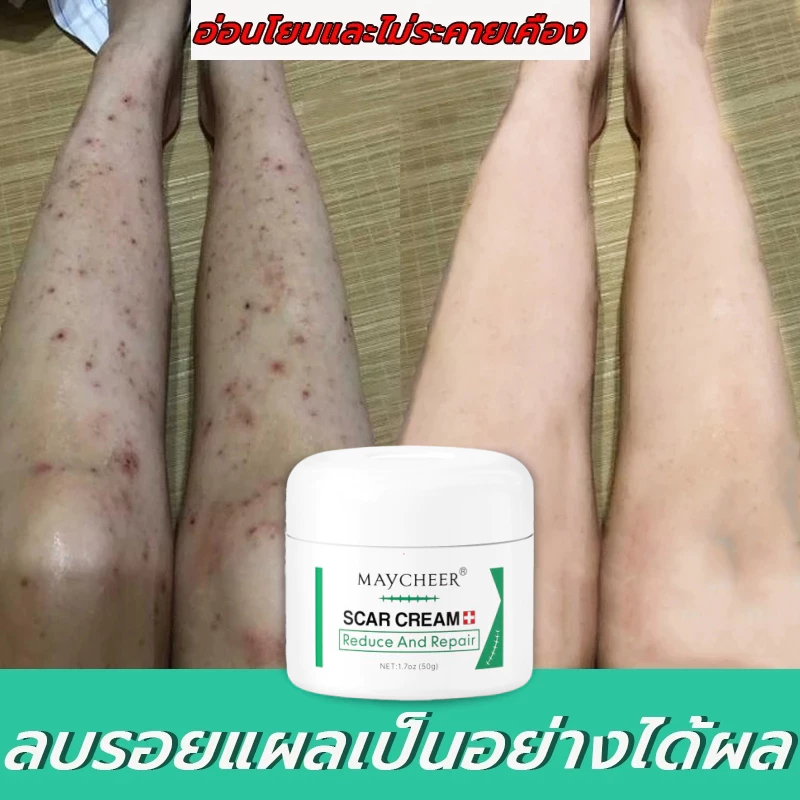 【มีสินค้าพร้อมจัดส่ง】ALIVER 50ml ครีมลดรอยแผลเป็น แผลเป็น ลดเลือนแผลผ่าตัดการคลอด แผลผ่าตัด แผลเป็นใหม่และแผลเป็นเก่า