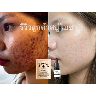 เซ็ท2ชิ้นสบู่ใบชา+เซรั่มใบชา สูตรแพทย์แผนไทย แถมตาข่ายตีฟอง