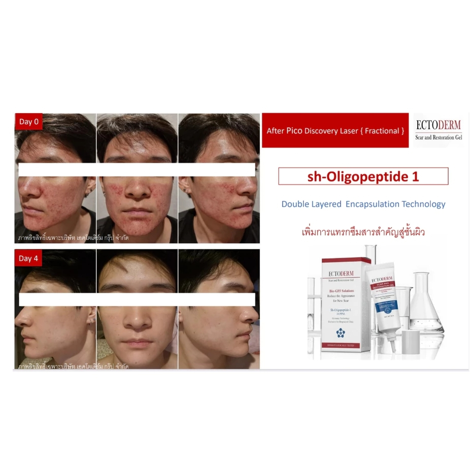 ECTODERM Scar and Restoration Gel +แถม ผลิตภัณฑ์ที่ช่วยสมานแผล Exp.26/12/2027