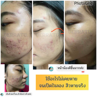 โฟมล้างหน้า 90g DERRATU ลดสิว ผดผื่น สิวยีสต์ สิวอุดตัน สิวอักเสบ สิวแพ้แมส ช่วยหน้านุ่มหลังล้าง