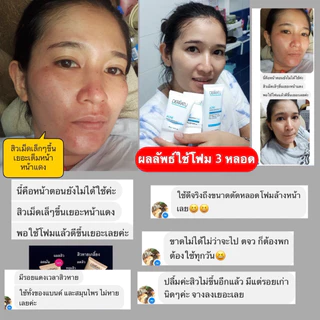 โฟมล้างหน้า 90g DERRATU ลดสิว ผดผื่น สิวยีสต์ สิวอุดตัน สิวอักเสบ สิวแพ้แมส ช่วยหน้านุ่มหลังล้าง