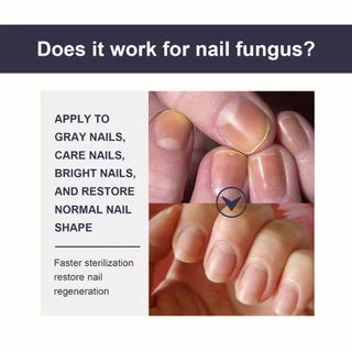 OUHOE เซรั่มเล็บ เชื้อราเล็บมือ Nail Care เซรั่มบำรุงเล็บ เซรั่มซ่อมแซมเล็บ และเล็บขบ บำรุงเล็บเสีย