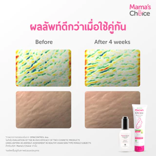 Mama's Choice ครีมลดรอยแตกลาย ครีมทาท้องลาย ลดรอยแตกลาย ท้องลาย ขาแตกลาย ปลอดสารเคมี - Stretch Mark Cream