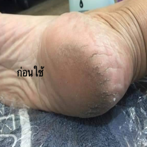 ศิรินา น้ำยาขัดส้นเท้า แก้ส้นเท้าแตกลาย ส้นเท้าแห้งแข็ง  SIRINA Foot Callus Remover ราคา ถูกที่สุด ดีลบีเคเค แกลเลอรีภาพที่ 4