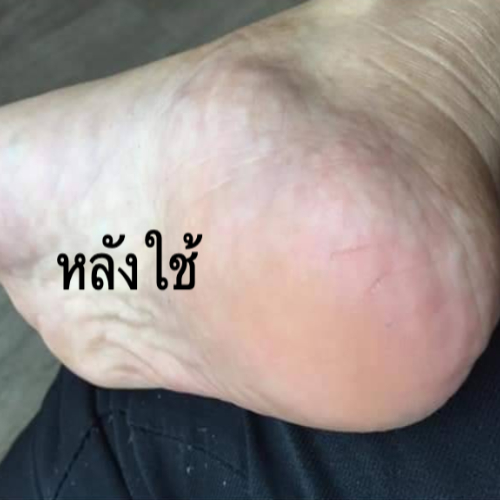ศิรินา น้ำยาขัดส้นเท้า แก้ส้นเท้าแตกลาย ส้นเท้าแห้งแข็ง  SIRINA Foot Callus Remover ราคา ถูกที่สุด ดีลบีเคเค แกลเลอรีภาพที่ 5