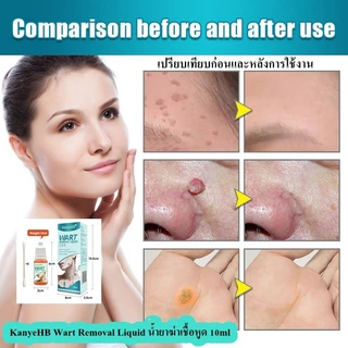 น้ำยาฆ่าเชื้อหูด 10ml KanyeHB's wart-removing liquid หูดหลุดได้อย่างรวดเร็ว
