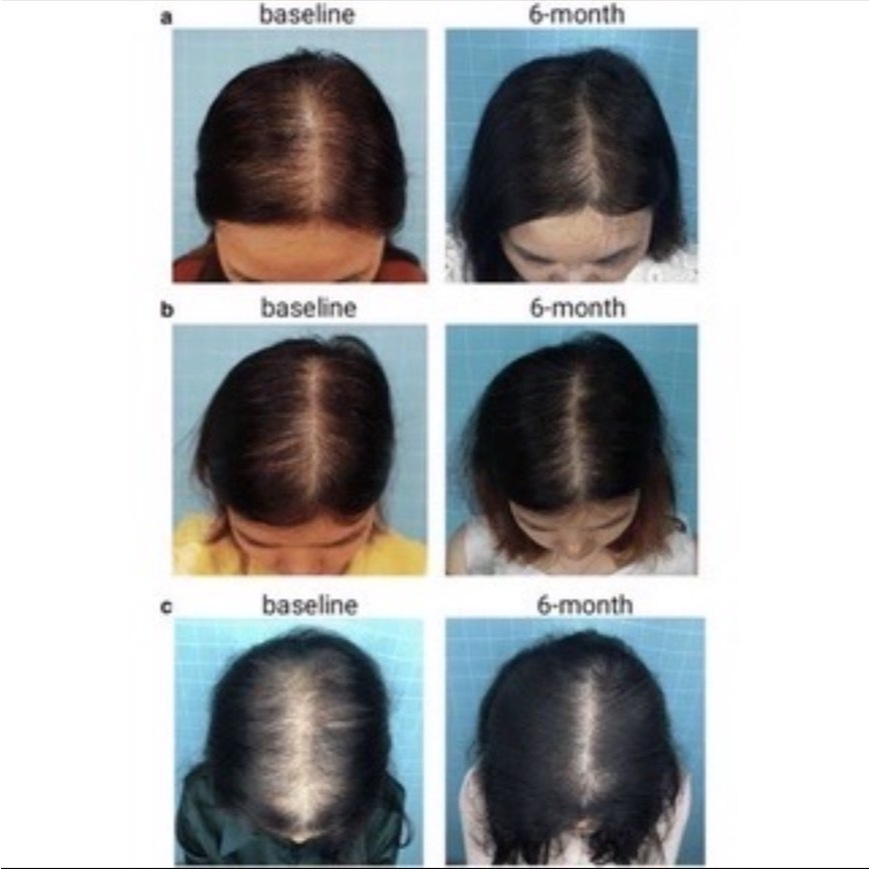 Hair Hero 15% plus biotin เซรั่มปลูกผม - รูปที่ 7