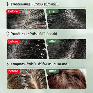 LYDIMOON แชมพูขจัดรังแค 500ml ยาสระผมลดรังแค ช่วยบรรเทาอาการคันหนังศีรษะ ทำความสะอาดหนังศีรษะ แชมพูรังแค
