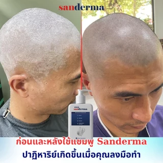 [พร้อมส่ง 300g] SANDERMA SHAMPOO แชมพูสมุนไพรธรรมชาติ ขจัดรังแค ลดอาการคัน ฟื้นฟูผมแห้งเสีย นุ่มสลวย