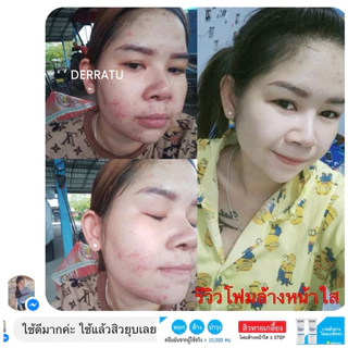 โฟมล้างหน้า 90g DERRATU ลดสิว ผดผื่น สิวยีสต์ สิวอุดตัน สิวอักเสบ สิวแพ้แมส ช่วยหน้านุ่มหลังล้าง