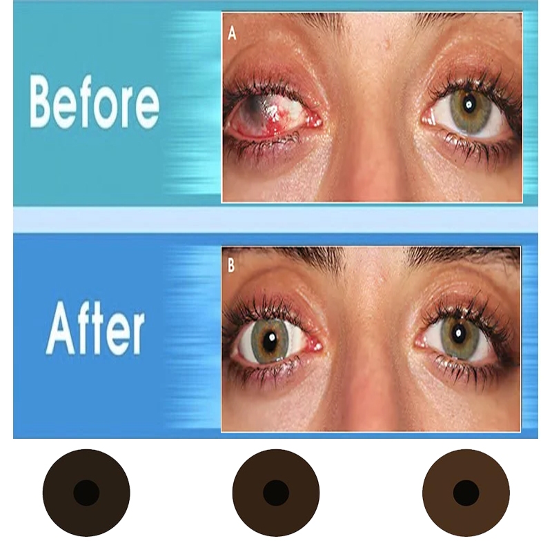 IRIS LENS คอนแทคเลนส์สำหรับผู้พิการทางสายตา Color lens (2 pcs)