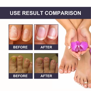 OUHOE เซรั่มเล็บ เชื้อราเล็บมือ Nail Care เซรั่มบำรุงเล็บ เซรั่มซ่อมแซมเล็บ และเล็บขบ บำรุงเล็บเสีย