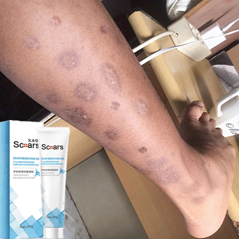 【มีสินค้าพร้อมจัดส่ง】Scars 20ml ครีมลดรอยแผลเป็น แผลเป็น ลดเลือนแผลผ่าตัดการคลอด แผลผ่าตัด แผลเป็นใหม่และแผลเป็นเก่า