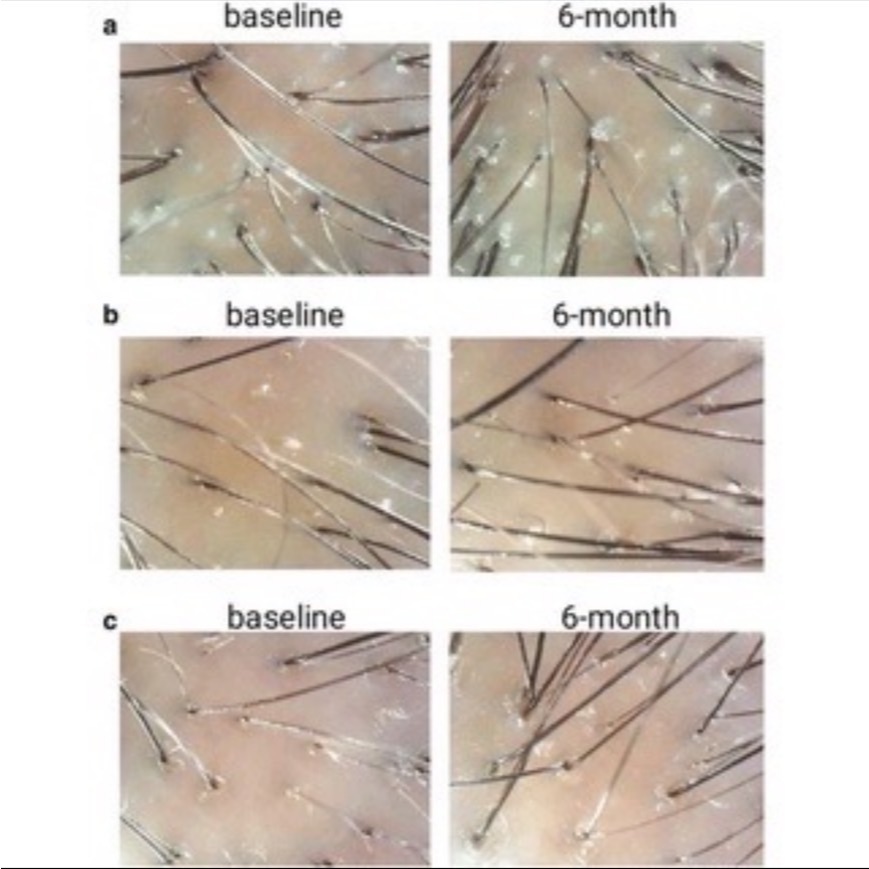 Hair Hero 15% plus biotin เซรั่มปลูกผม - รูปที่ 6