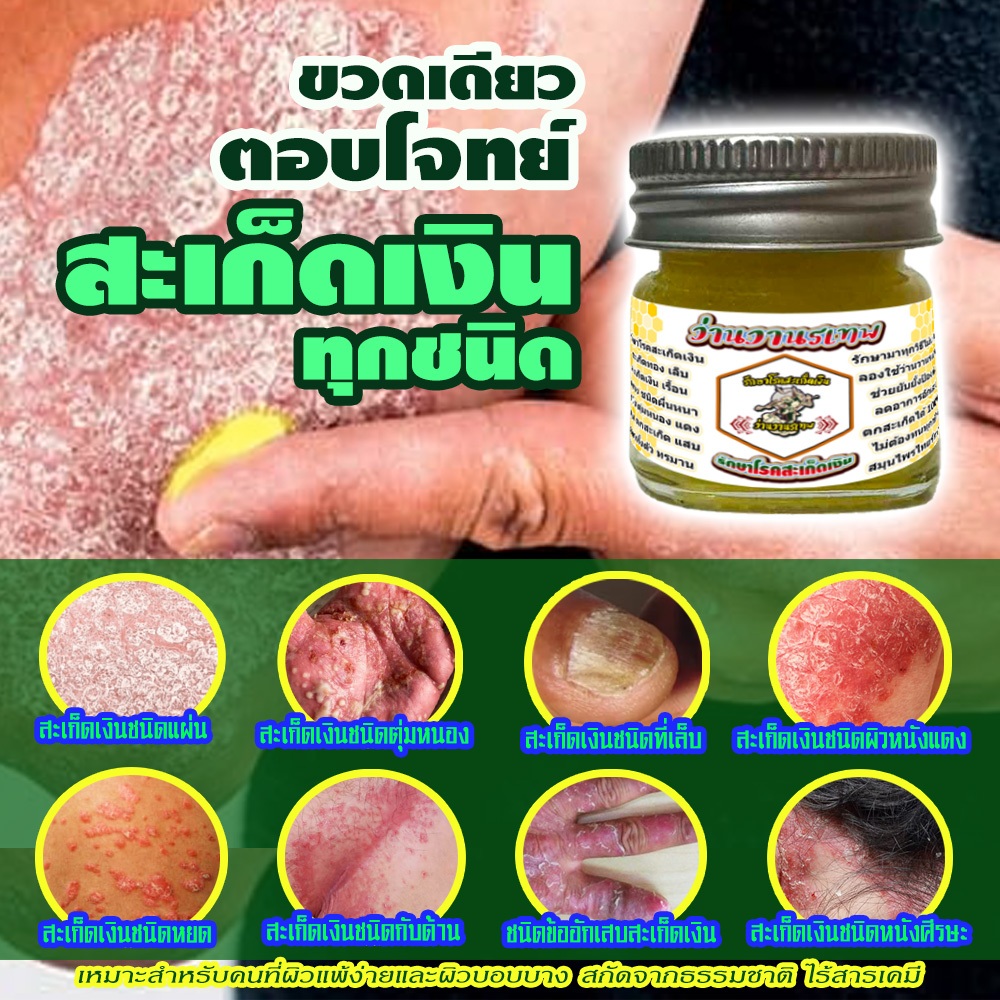 ปราบกำจัด สะเก็ดเงิน เรื้อนกวาง ตัวช่วยกำจัดแก้ สะเก็ดเงิน เรื้อนกวาง ให้คุณหมดกังวลปัญหาขัดลอกผิวหน้ามือเท้า