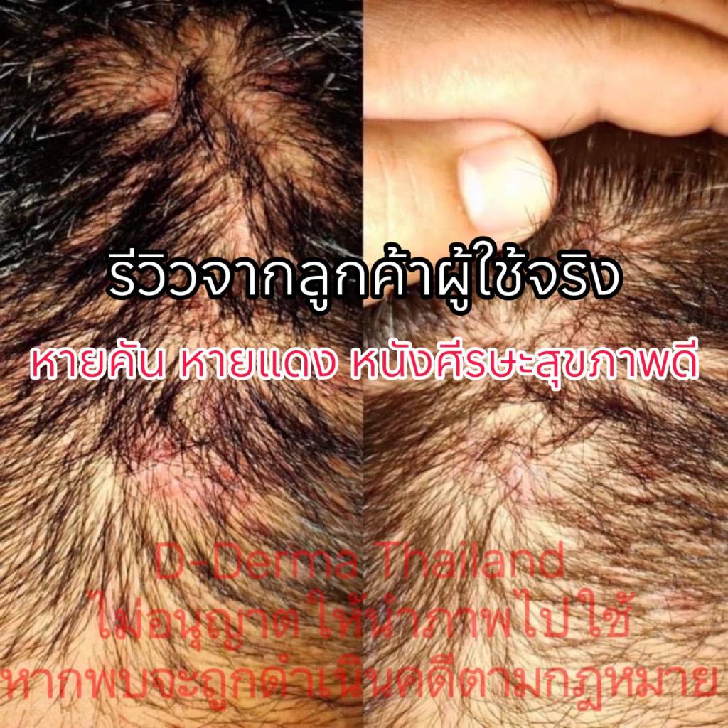 (บริษัท) เซ็ทแชมพูและเซรั่มดูแลหนังศีรษะ รังแค หนังศีรษะลอก ศีรษะอักเสบ เซ็บเดิร์ม ต่อมไขมันอักเสบ