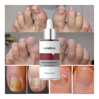 LANBENA เจลซ่อม ดเชื้อราที่เล็บโรคเชื้อราที่เล็บ ​โรคเชื้อราที่เล็บครีมบํารุงผิวนิ้วเท้า บำรุงเล