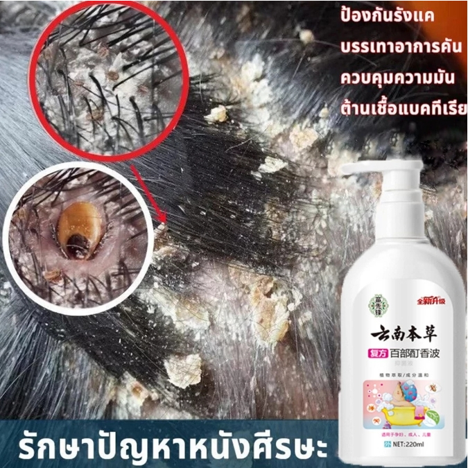 แชมพูกำจัดเหา ยาฆ่าเหา กำจัดเหาและไข่ แก้คัน กลิ่นหอม อ่อนโยน ยาสระผมฆ่าเหา ยาฆ่าเหา น้ำยากำจัดเห่า 220 ml