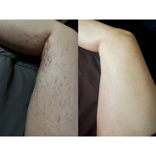 ครีมนวลจันทร์ ลดรอยแตกลาย ของแท้100% (กดผ่านไลฟ์ หรือวิดีโอ30 %ลดสูงสุด 100)