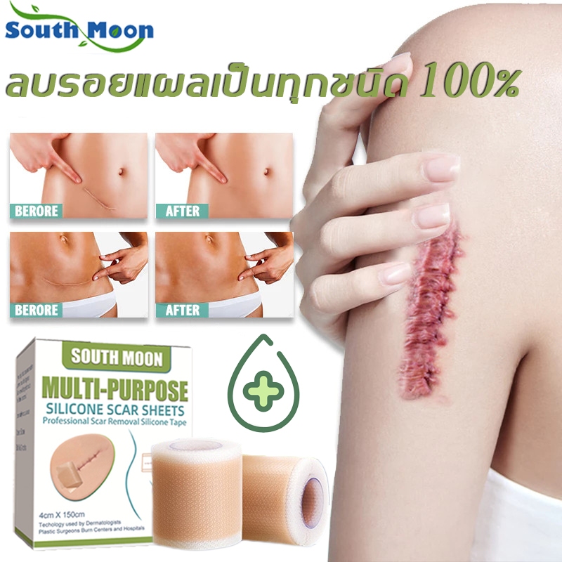 【จัดส่งจากกรุงเทพฯ】South Moon แผ่นแปะแผลเป็น กําจัดรอยแผลเป็นจากแผลเป็น ปิดรอยแผลเป็น ตัดตามต้องการ