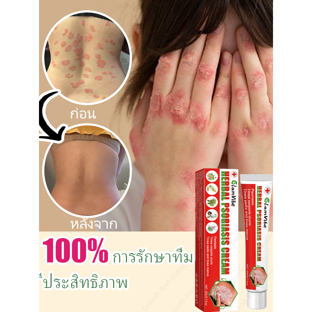 พร้อมส่ง🚀 ซื้อ 5 แถม 5 ฟรี 🔥ครีมทาผิวหนังสะเก็ดเงิน บรรเทาอาการคันอย่างรวดเร็ว และฟื้นฟูผิวบรรเทาอาการคันและลอกเป็นขุย