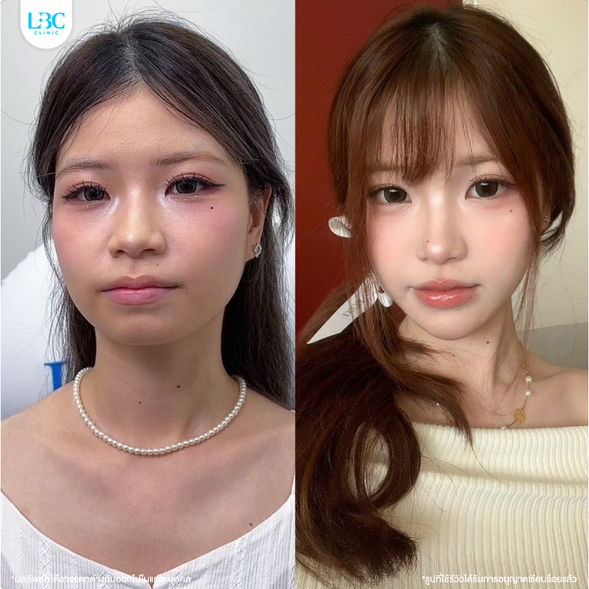 LBC Clinic โปร Size XXL ลดกราม+ลิฟท์หน้า+สลายไขมัน Lipo V 6 เข็ม