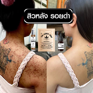 เซทรักษาสิวหลัง หน้า อก ไหล่ SET 6ชิ้นสุดคุ้ม สบู่+สเปรย์+เซรั่มใบชาสูตรแพทย์แผนไทย+ตาข่ายตีฟอง+ใยบวบ+แปรงขัดหลัง