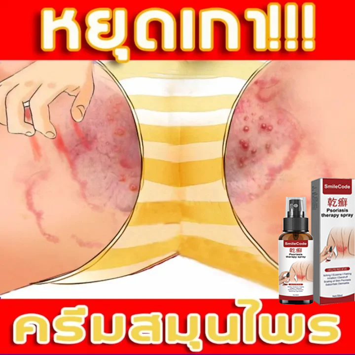 ครีมลดอาการคัน30ML ทาแก้คัน ผิวหนังทากากเกลื้อน สารสกัดจากพืชใช้ได้ทั้งตัวบอกลาผิวคันได้ง่ายๆ Psoriasis eczema cream