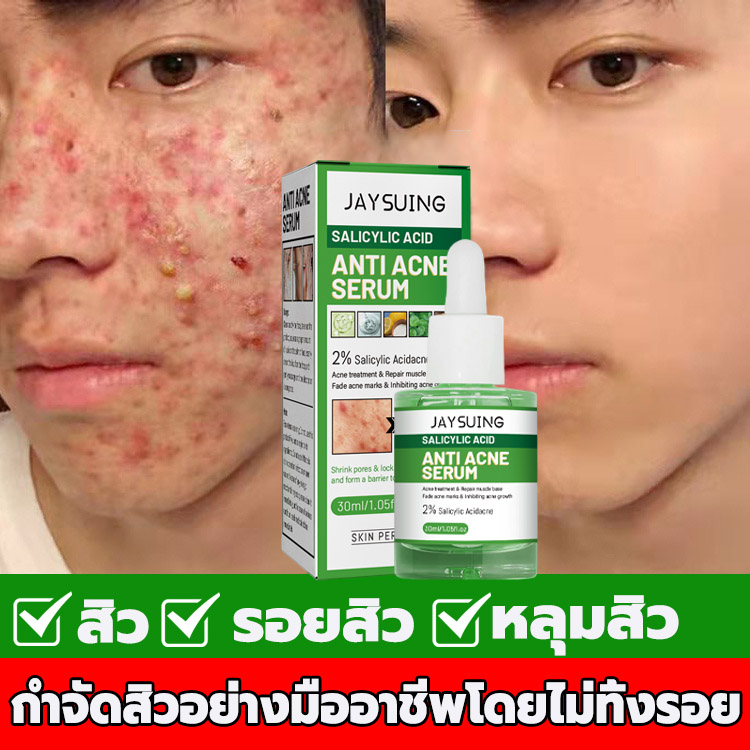ครีมกำจัดสิว 30g ลดสิวอุดตัน ช่วยลดรอยสิว ไม่อุดตันผิว รูขุมขนกระชับ