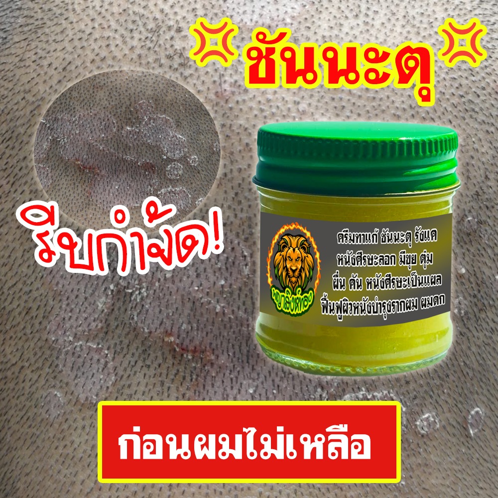 บาล์มเจลสูตรพิเศษสำหรับคนเป็นชันนะตุ หนังหัวลอกเป็นขุยเจ็บหัว รังเเค หนังศรีษะเเห้งลอก