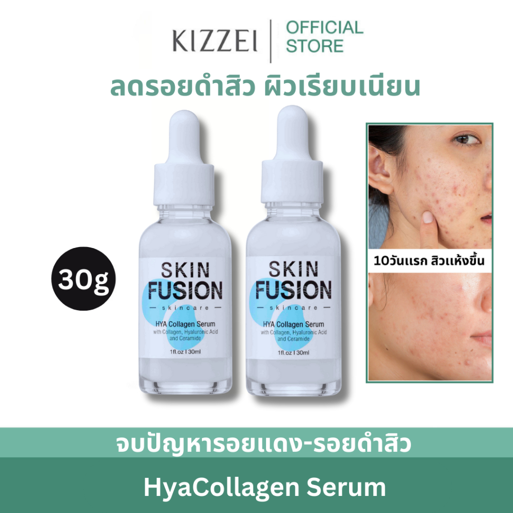 Kizzei Acne ผลิตภัณฑ์ดูแลสิว เจลแต้มสิวอุดตัน เซรั่มลดรอยสิวหน้าใส โฟมดีท๊อกสิว รูขุมขนกว้าง รอยดำสิว สิวอักเสบ คุมมัน