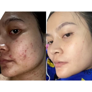 เซ็ท2ชิ้นสบู่ใบชา+เซรั่มใบชา สูตรแพทย์แผนไทย แถมตาข่ายตีฟอง