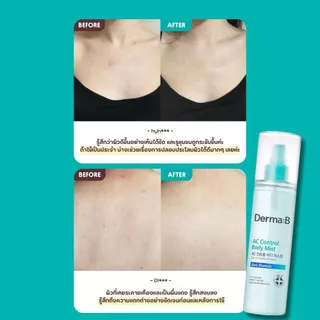 Derma: B AC Control Body Mist 200ml