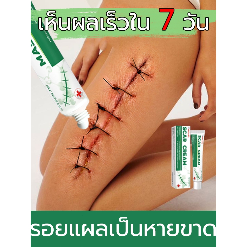 [ข้อพิสูจน์การกำจัดรอยแผลเป็นใน 5 วัน] กำจัดรอยแผลเป็นต่างๆ ได้หลากหลาย พิสูจน์แล้วว่ามีประสิทธิภาพโดยแพทย์ผิวหนัง มีผู้