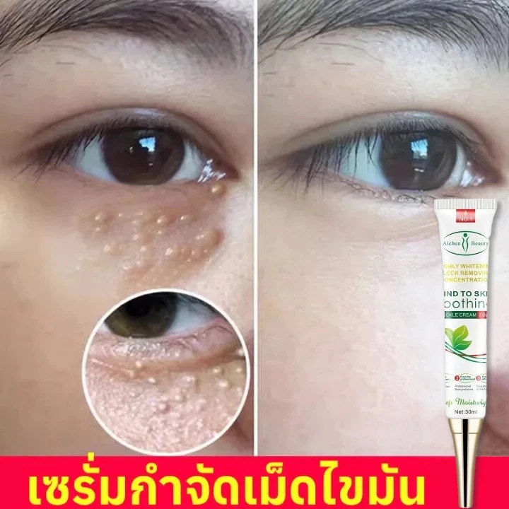 เม็ดไขมัน 30ml ลบคล้ำบวมใต้ตา กระชับรอยตีนกา ลดเม็ดไขมัน ฟื้นฟูผิวตา ครีมทารอบดวงตา เซรั่มอายครีม อายครีม