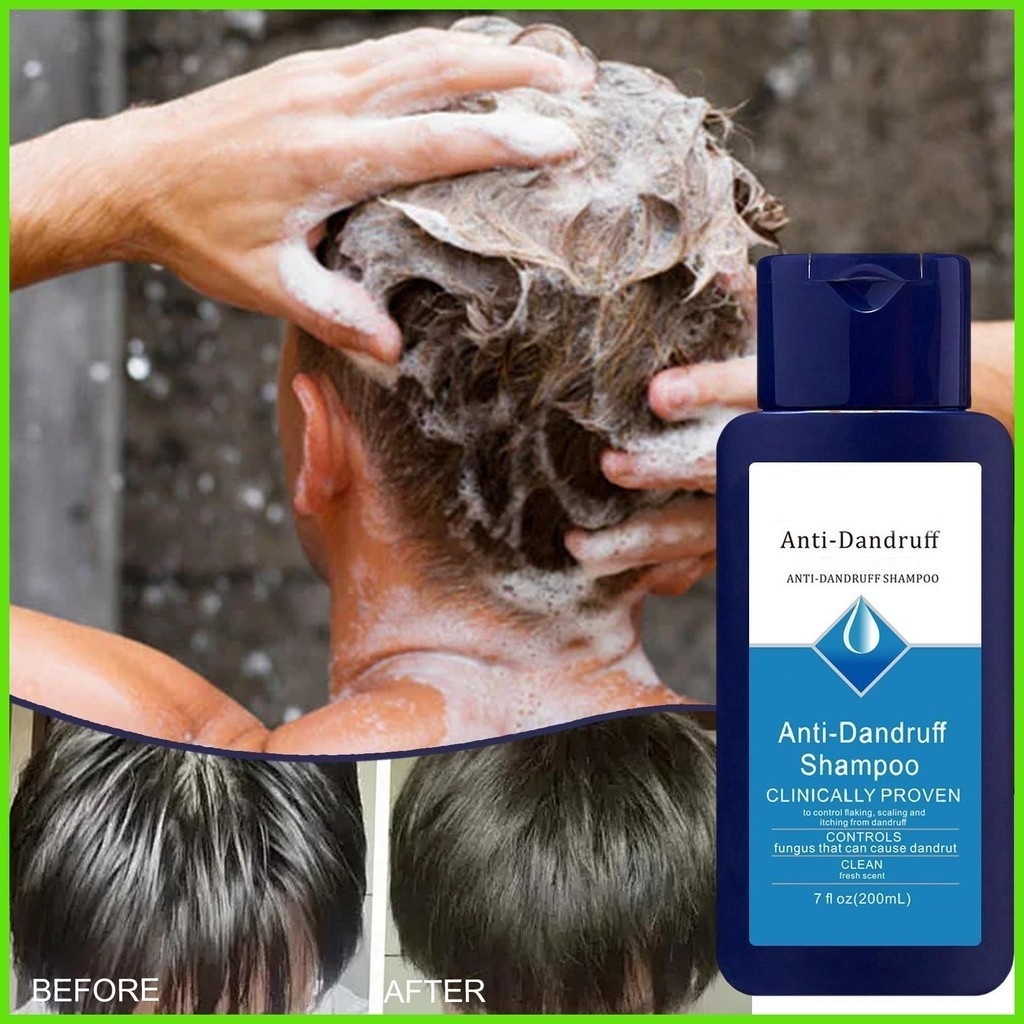 Nizoral Anti-Dandruff Shampoo 200ML Scalp Dandruff (LARGEST SIZE)