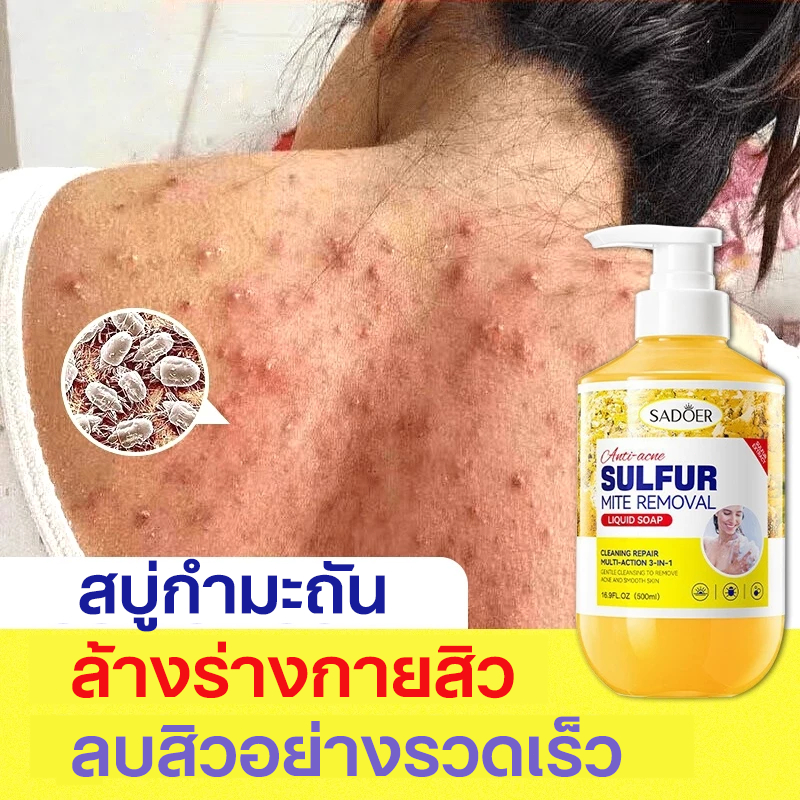 ต้านเชื้อแบคทีเรีย ล้างร่างกาย สิว ล้างร่างกาย เจลอาบน้ำป้องกันไร 500ml ส่วนผสมกำมะถัน ป้องกันไร ต้านเชื้อแบคทีเรียที่แข