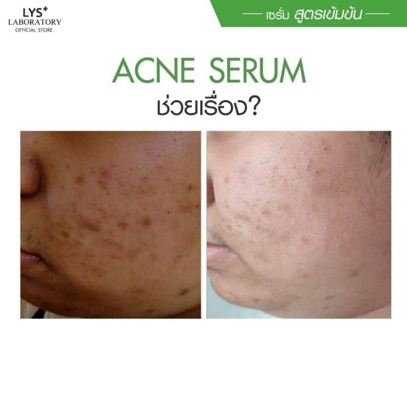 [🔥ส่งฟรี]LYS Acne Serum งานวิจัยรับรอง สิวผด สิวฮอร์โมน 30 ml