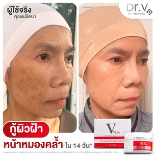 ครีมลดฝ้ากระและจุดด่างดำ Dr. V Advanced repair cream