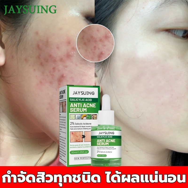 เซรั่มลดสิว 30ml ครีมกำจัดสิว ครีมลดสิว เจลแต้มสิว เจลรักษาสิว ครีมแต้มสิว ครีมรักษาสิว กำจัดสิว รอยสิวจางลง ลดรอยสิว