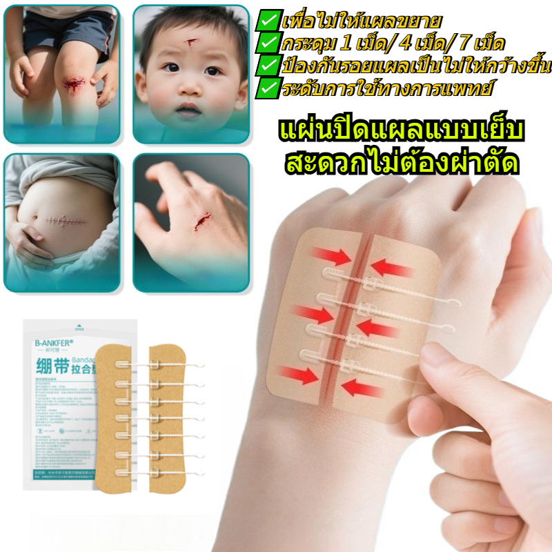 แผ่นปิดแผลแบบซิปที่ไม่ต้องเย็บ ช่วยลดการดึงรั้งของแผล ช่วยให้แผลหายเร็วขึ้น ผ้าพันแผลซิป ลดการดึงตึง🚑#รักษาบาดแผล